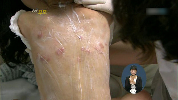 [60분부모] 아토피가 아이의 자존감을 낮춘다 ① | 인스티즈