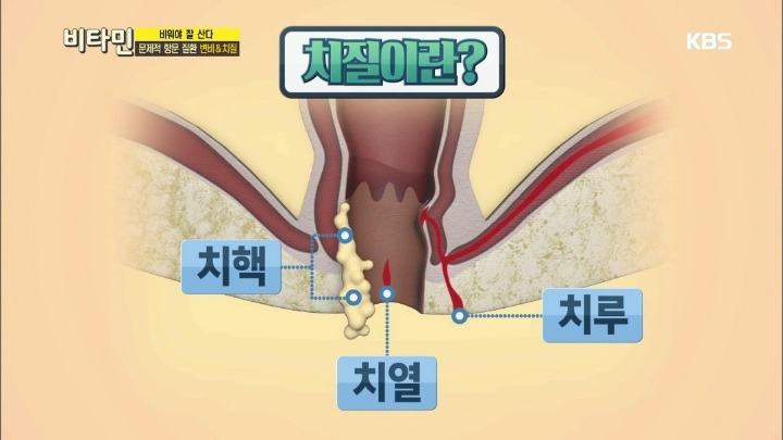 항문이 간지럽다면? | 인스티즈
