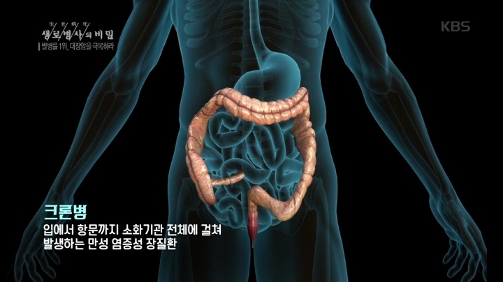 젊은 대장암이 늘고 있다.jpg | 인스티즈