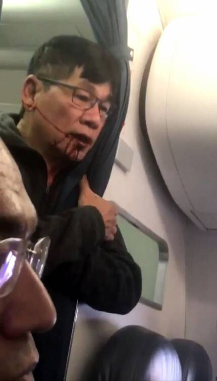 유나이티드항공 피해자 "영구적 뇌 손상 가능성 있다" | 인스티즈