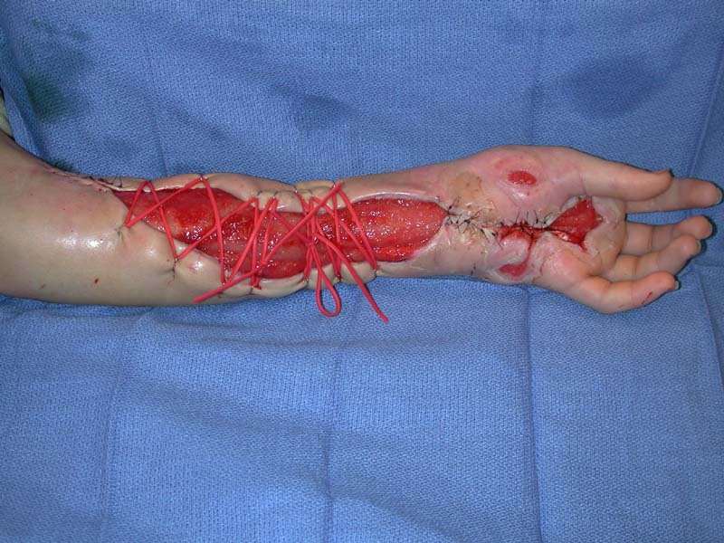 혐오))적나라함 주의)) 방울뱀에게 물린 사람의 치료과정 | 인스티즈