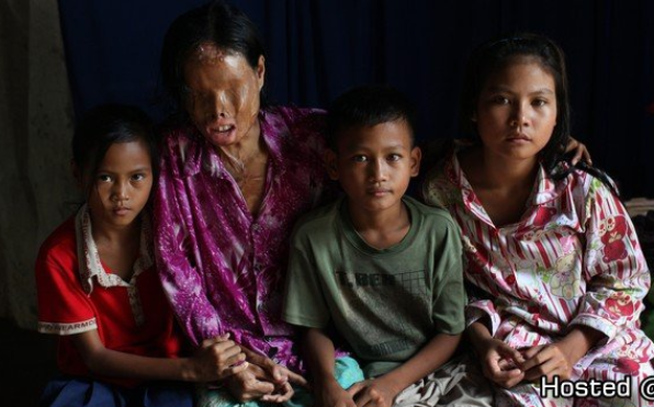 캄보디아 남편에게 산성 공격 당한 여성 (혐오주의) | 인스티즈