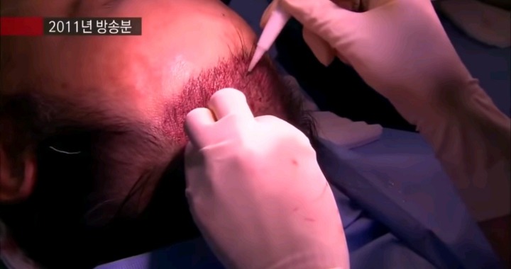 실제 모발이식 수술 장면.jpg (사진주의) | 인스티즈